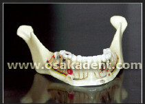 Forma dental del modelo de enseñanza de implantes dentales.