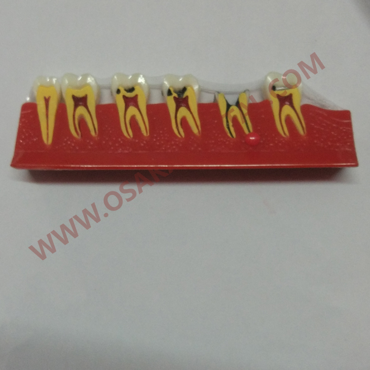 OSA-4011A Caries Forma de los dientes del modelo de enseñanza dental / modelo dental / pieza de mano dental / equipo dental