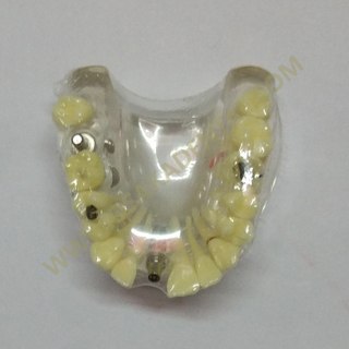 Modelos de implantes dentales OSA-2008A con modelo de caries / dientes / modelo dental / modelo dental / pieza de mano dental / unidad de silla dental