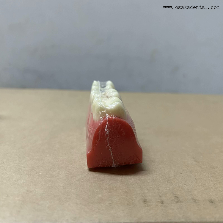 Modelo de demostración de sellador de fisuras y fosas dentales 