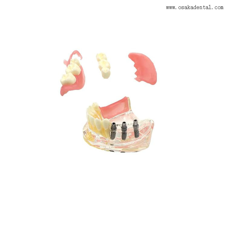 Modelo comparativo de restauración de implantes dentales para la enseñanza del dentista