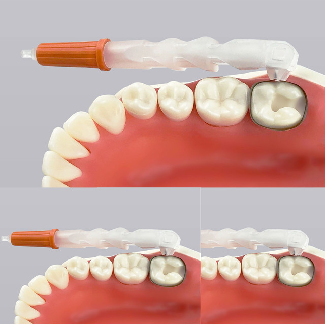 Nuevo retenedor y matriz sin alas dentales desechables