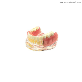 Modelo comparativo de restauración de implantes dentales para la enseñanza del dentista