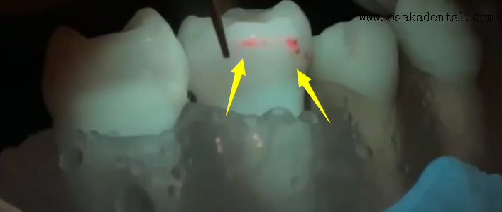 Nuevo modelo de mano dental con caries detectando caries de detección de caries con pie de mano del generador con iluminación