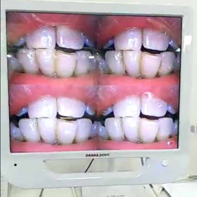 Cámara intraoral dental de 17 pulgadas con monitor y soporte metálico.