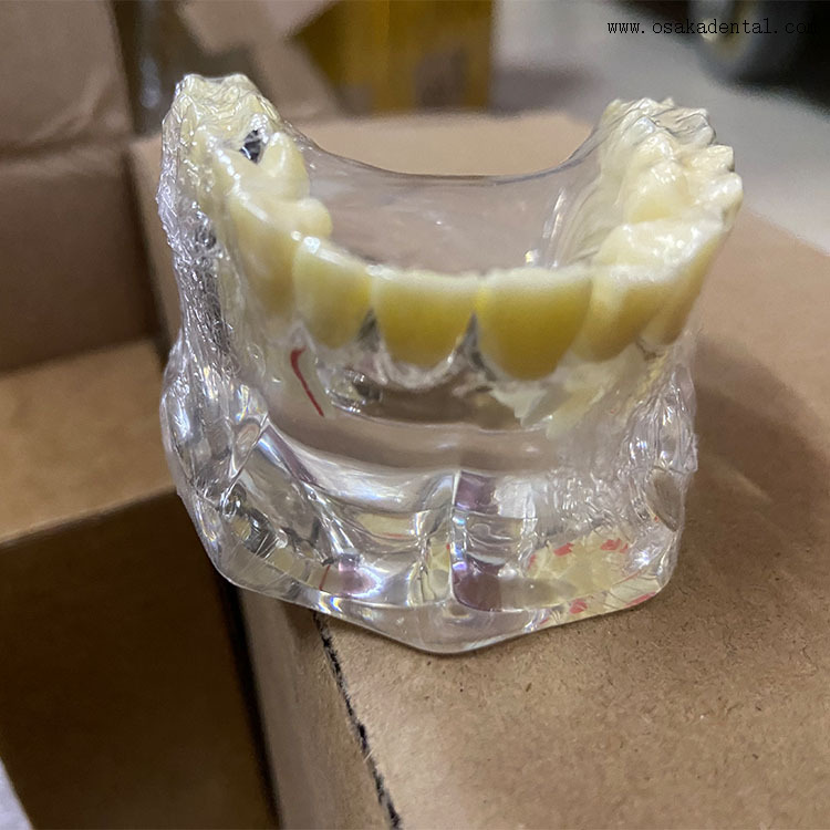 Modelo comparativo de restauración de implantes dentales para la enseñanza del dentista