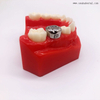 Ortodoncia Dental Acero Inoxidable Corona Infantil OSA-P30