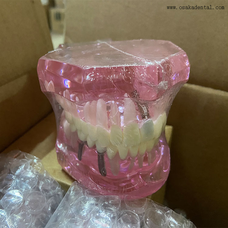 Modelo de implante de dientes dentales para la enseñanza del dentista