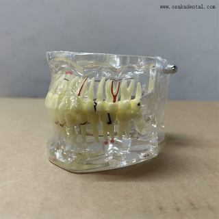 Modelo de patología dental para la enseñanza del dentista.