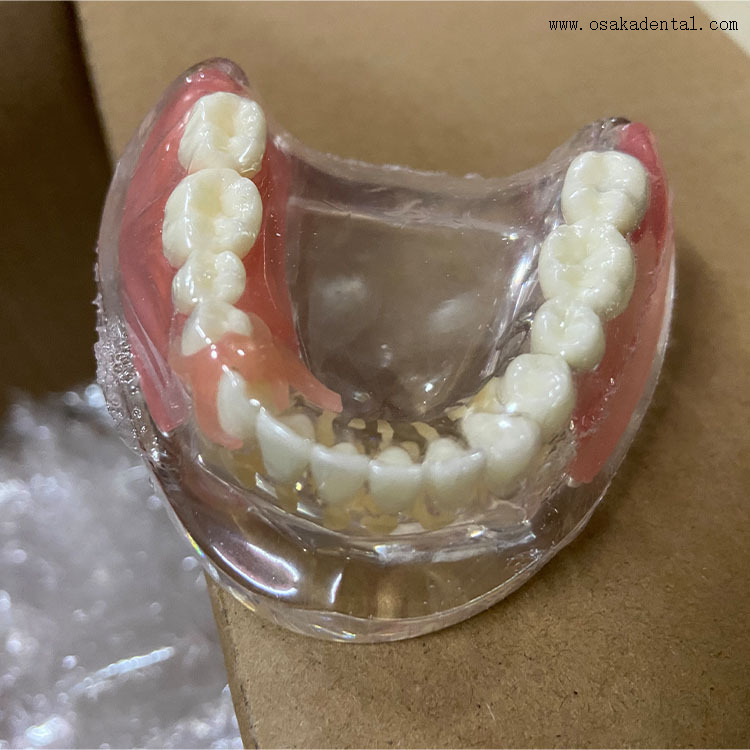 Modelo comparativo de restauración de implantes dentales para la enseñanza del dentista