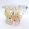 Modelo de implante dental patológico dental para practicar