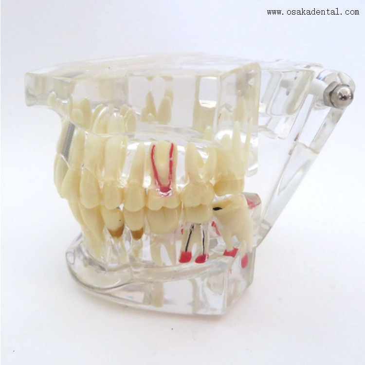 Modelo de implante dental patológico dental para practicar