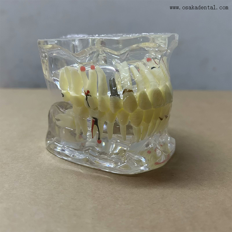 Modelo de patología dental para la enseñanza del dentista.