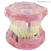 Modelo de implante de dientes dentales para la enseñanza del dentista