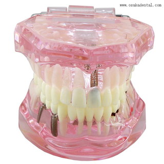 Modelo de implante de dientes dentales para la enseñanza del dentista