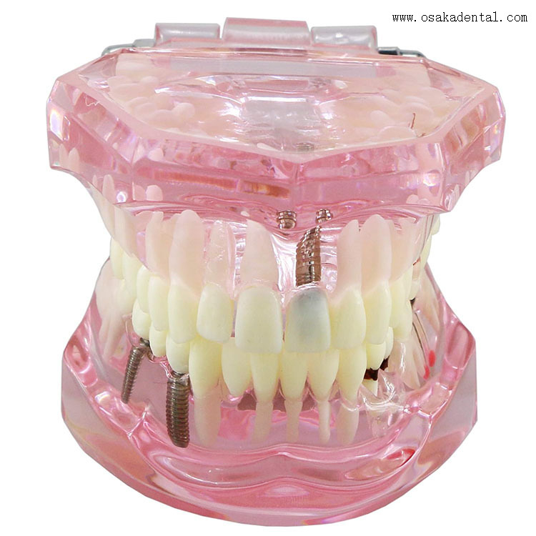 Modelo de implante de dientes dentales para la enseñanza del dentista