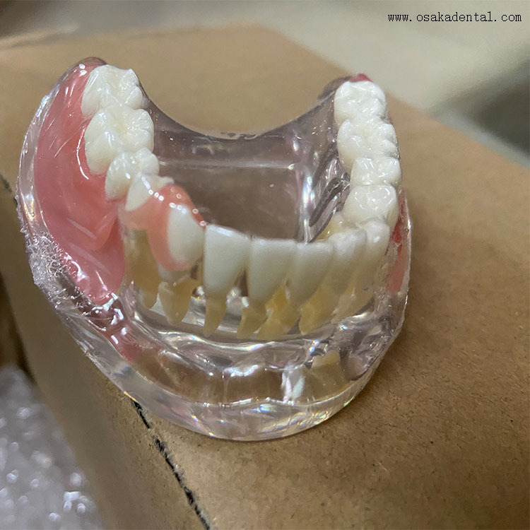 Modelo comparativo de restauración de implantes dentales para la enseñanza del dentista