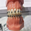 Soporte de metal de autoligado dental para ortodoncia dental