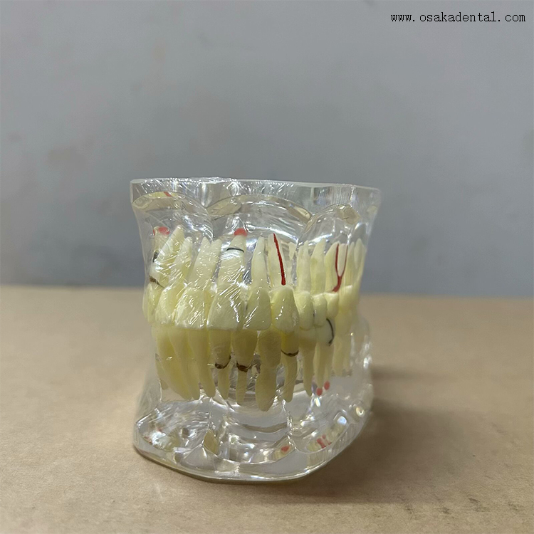 Modelo de patología dental para la enseñanza del dentista.