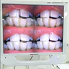 Cámara intraoral dental de 17 pulgadas con monitor y soporte de metal