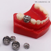 Accesorios de ortodoncia dental corona de metal para niños para niños.