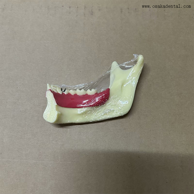Modelo de dientes de descomposición mandibular dental 